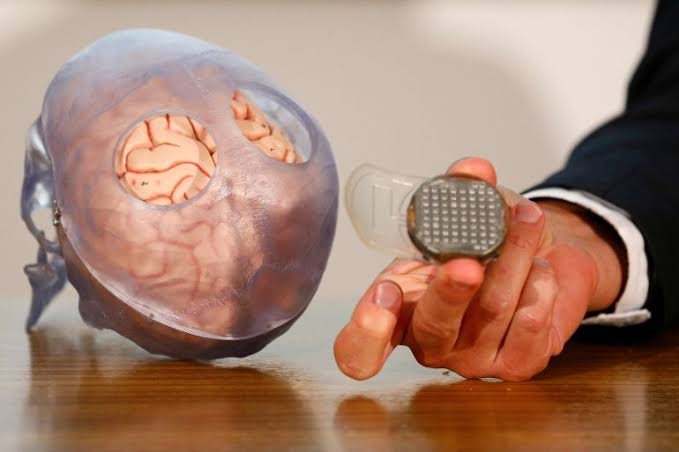32-yr Patient Receives Microchip Implanted in His Brain